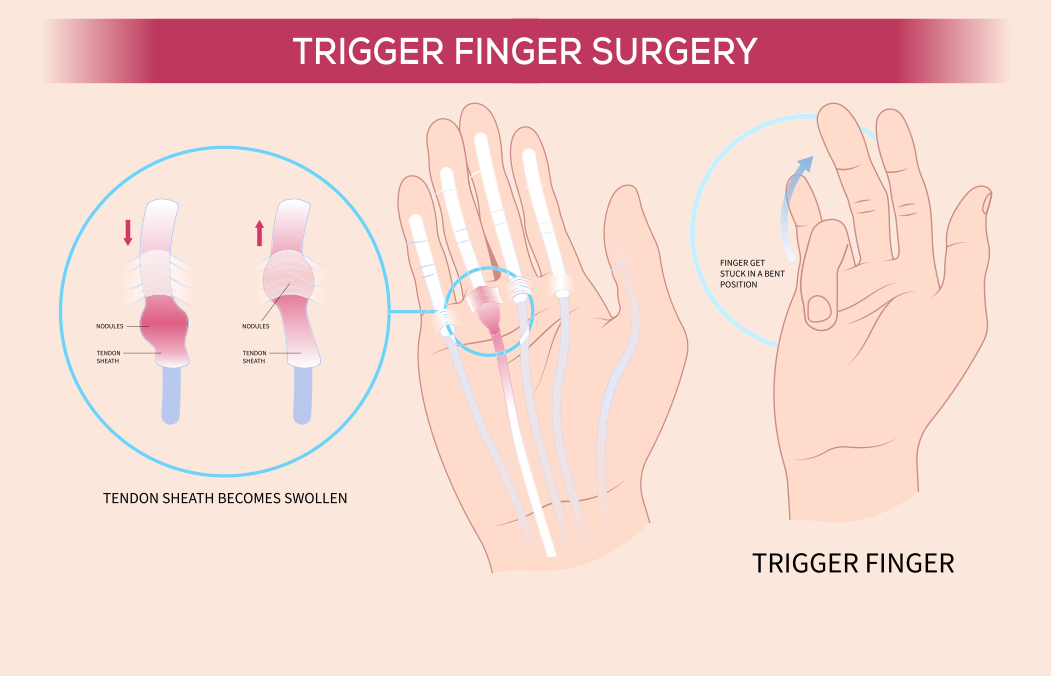 Common Reasons For Trigger Finger Surgery